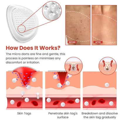 Derma Smooth Skin Tag Removal Patch | 🔥BUY 1 GET 1 FREE🔥