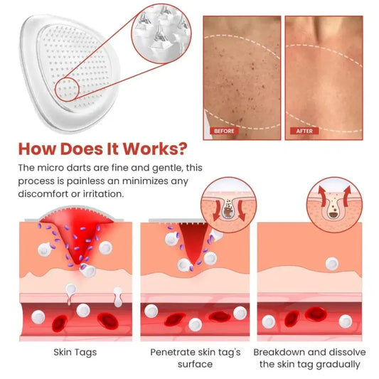 Derma Smooth Skin Tag Removal Patch | 🔥BUY 1 GET 1 FREE🔥